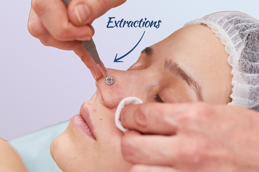 https://skintypesolutions.com/cdn/shop/articles/facial-extractions-419441.jpg?v=1692389161