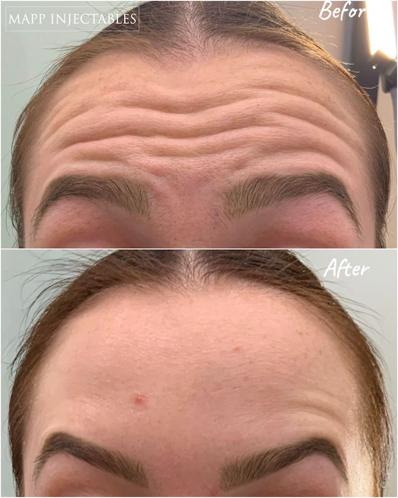 https://cdn.prod.website-files.com/60613ac39a7d3d4937fee19f/64deb523341e88775be9c702_forehead%20results%2014days%20botox.JPG